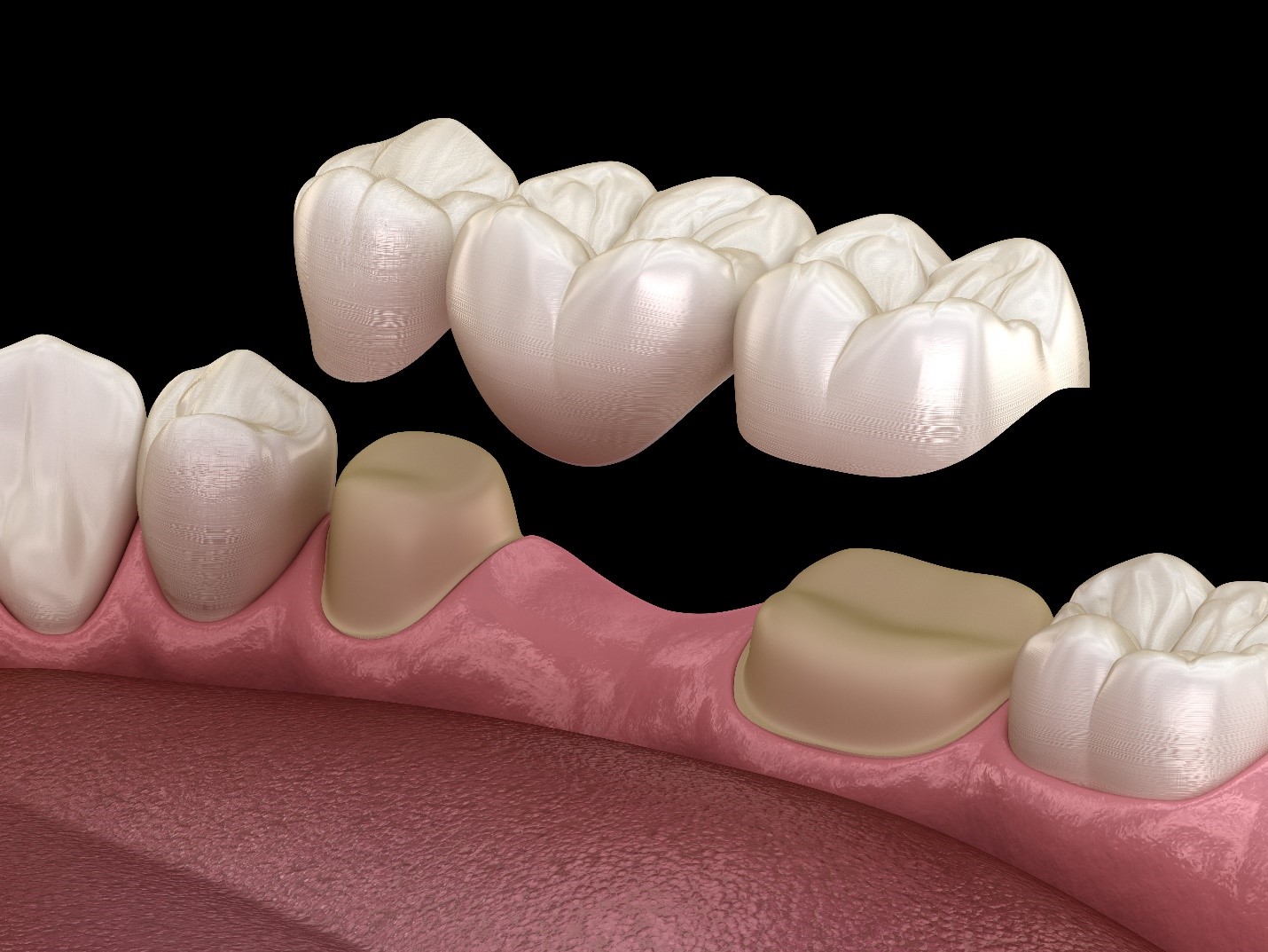 dental crowns and bridges